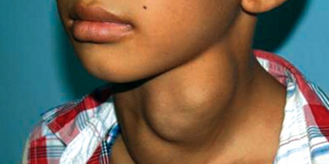 गलगाड निवारणका लागि एक महिनासम्म आयोडिन महिना मनाइने