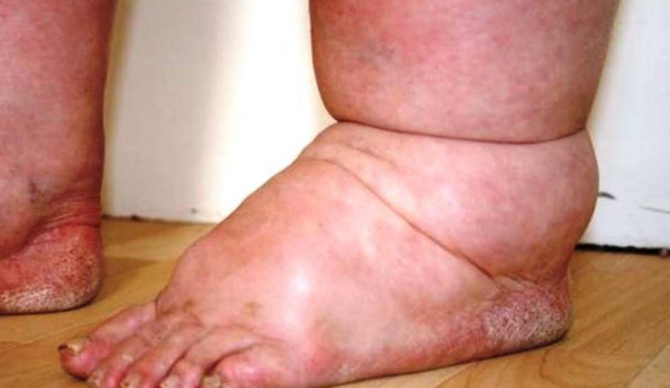 फेरि भेटियो हात्तीपाइलेको जीवाणु