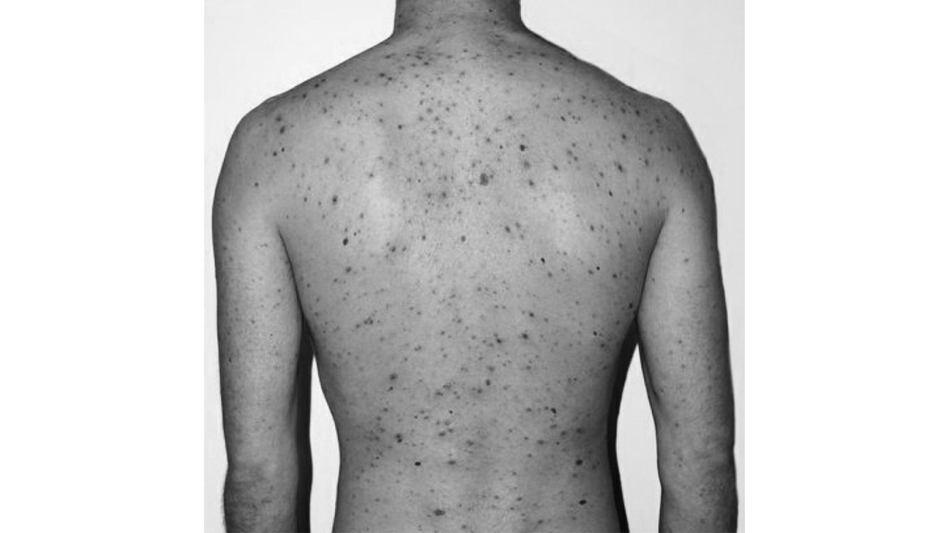 दादुरा फैलिएपछि नेपालगञ्ज उपमहानगरद्धारा २ दिन सार्वजनिक विदा प्रदान