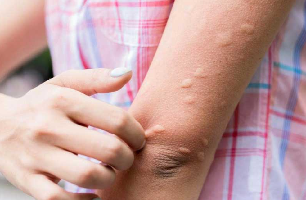 दुई महिनामा जापानी इन्सेफ्लाइटिसबाट नौ जनाको मृत्यु