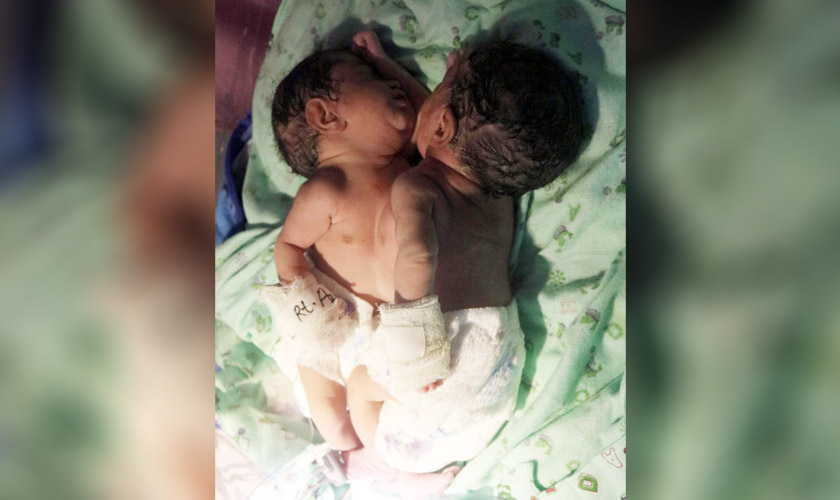 पेटदेखि छातीसम्म शरीर जोडिएकी जुम्ल्याहा बालिकाको जन्म