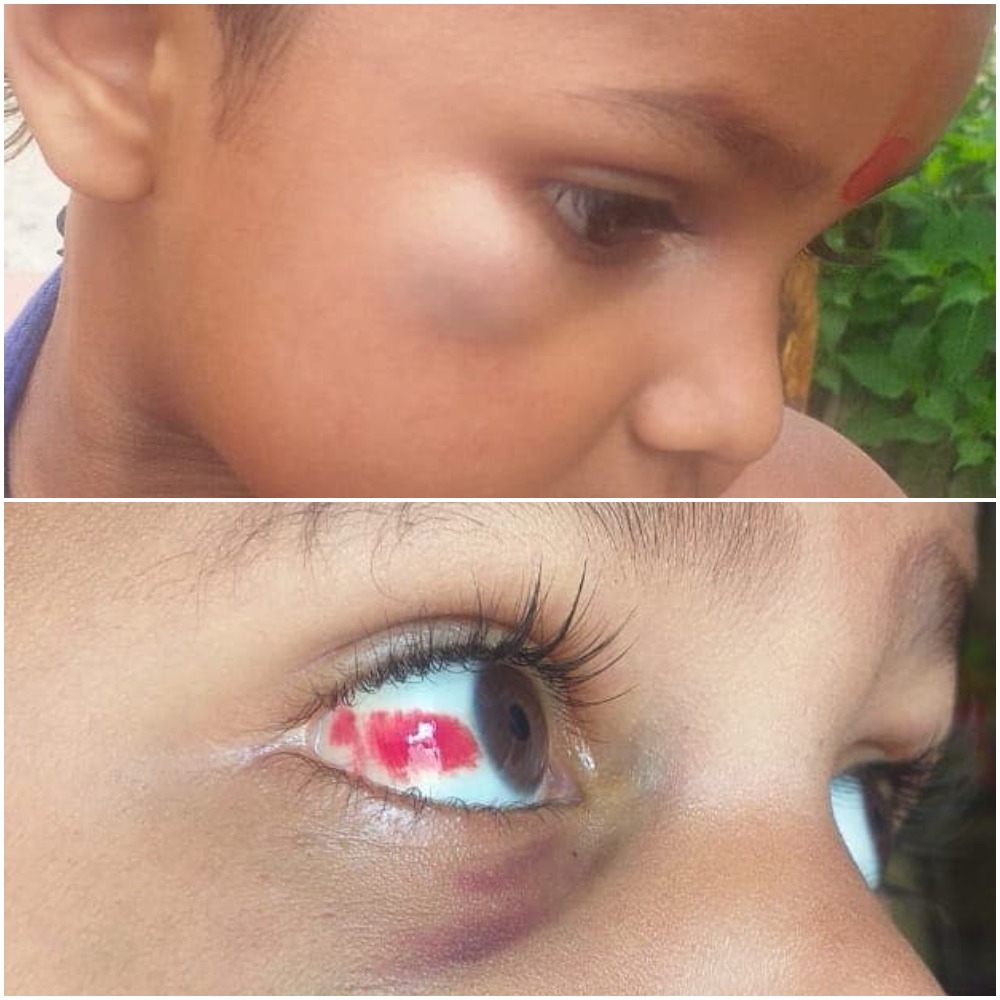 विद्यालय गएका ४ बर्षिय बालक आँखामा चोट लिएर फर्किए