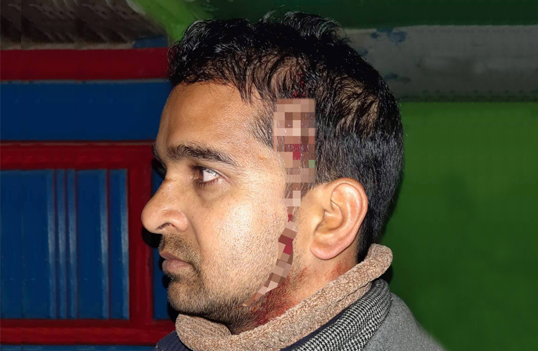 आठबीसकोट नगरपालिकाका प्रमुख प्रशासकीय अधिकृतमाथि आक्रमण, टाउकोमा ४ वटा टाँका