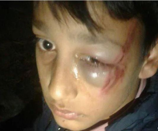 शिक्षकबाट विद्यार्थी निर्घात कुटिए