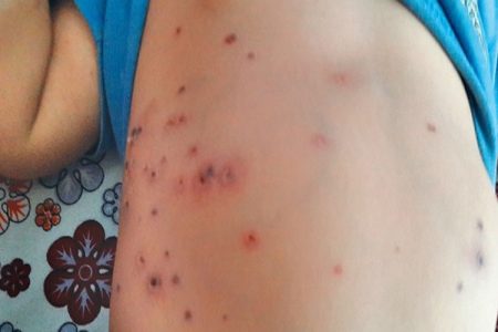 1568789501scrub_typhus