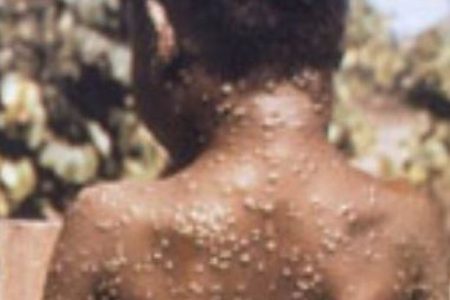 2_Monkeypox-was-diagnosed-in-a-man-visiting-a-naval-base-in-Cornwall