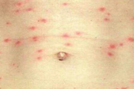 SCRUB_Typhus_A04q3K7Dl9