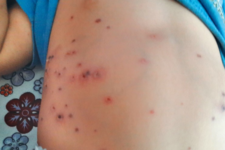 Scrub Typhus
