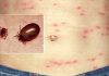 Scrub-Typhus
