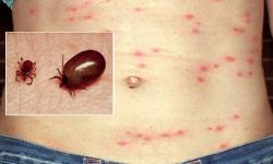 Scrub-Typhus