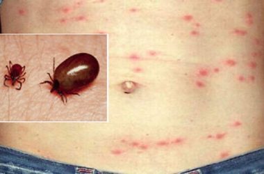 Scrub-Typhus