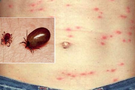 Scrub-Typhus