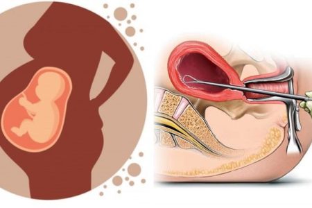 aboration-picture
