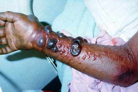 ebola-hemorrhagic-bleeding