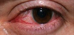 eye_infections