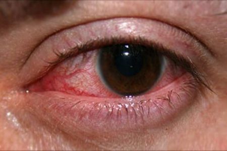 eye_infections