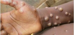 monkey-pox-news-1652167324
