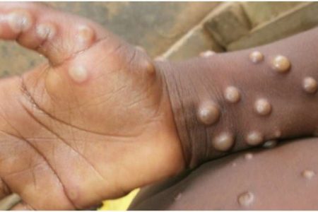 monkey-pox-news-1652167324