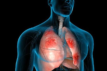 pneumonia