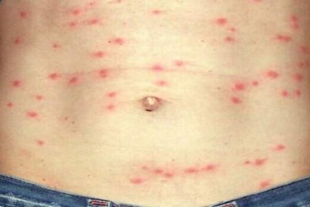 scrub-typhus