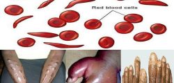 sickle cell