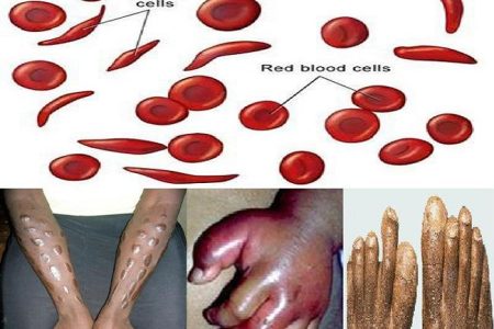 sickle cell