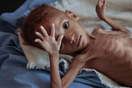 yemen-hunger-child-ap-ps-181121_hpMain_16x9_992